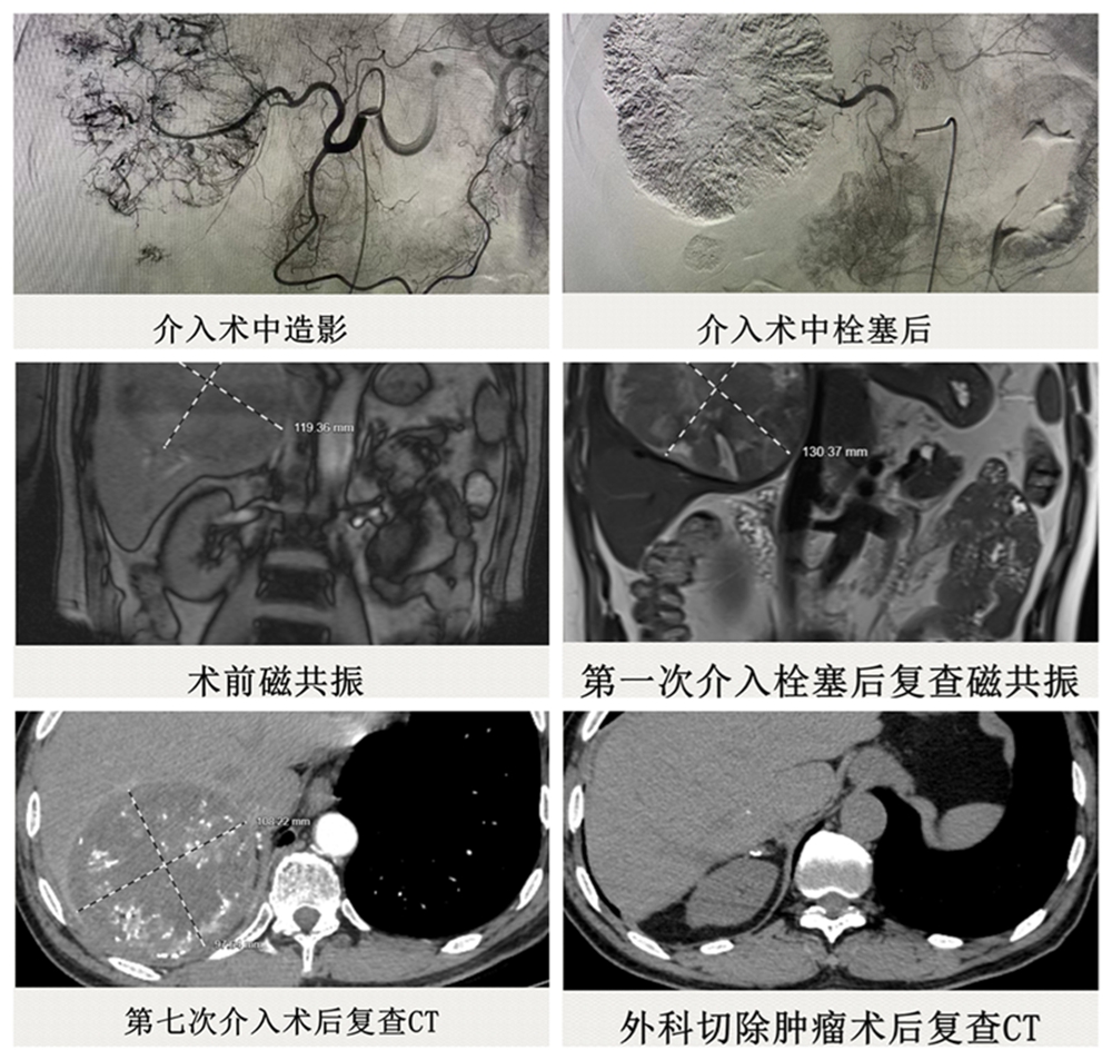 介入术中栓塞后_副本.jpg