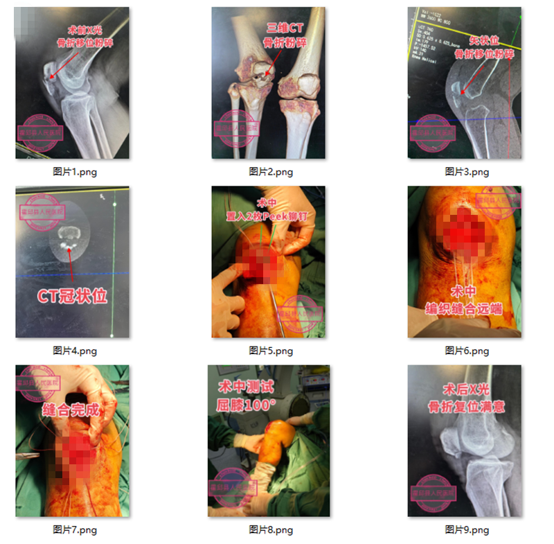 骨_副本.png 骨_副本.png